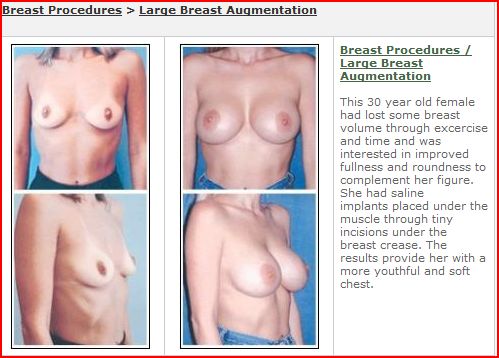 houston breast augmentation breast enlargement