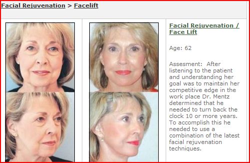 houston facelift texas face lift